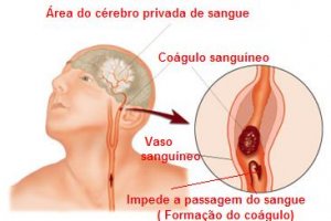 Trombose e causado por virus ou bacteria